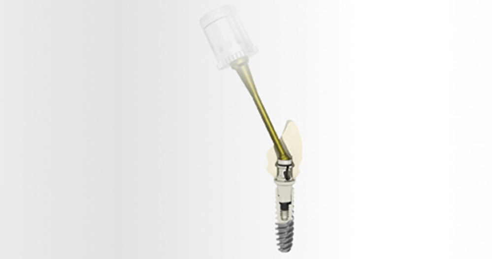 Anthogyr innova con AxIN®, un dente Simeda avvitato personalizzato in zirconia