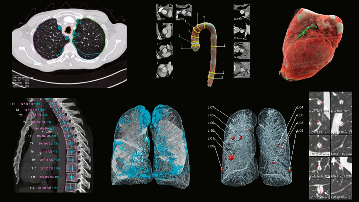 Applicazione del software di intelligenza artificiale di Siemens Healthineers