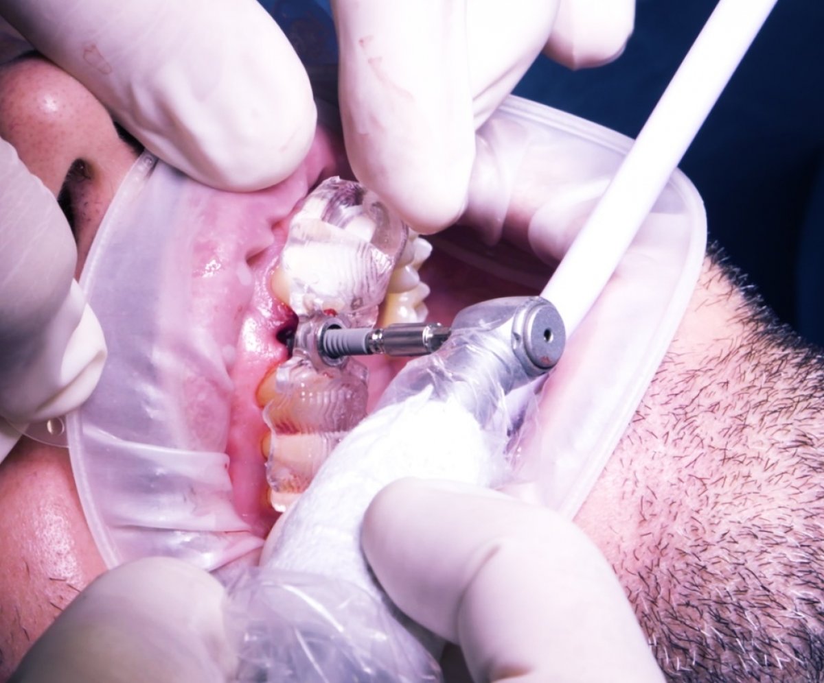 Implantologia completamente guidata con CEREC Guide 3