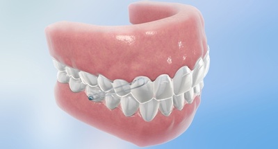 Invisalign G3 di Align Technology per trattare le malocclusioni