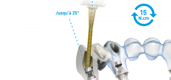 L'accesso angolato Anthogyr per le protesi Simeda® Connect® migliora il comfort