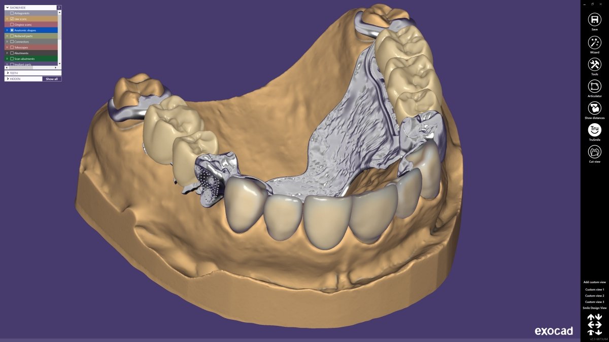 La cooperazione tra Dentsply Sirona ed exocad fa progredire il flusso di lavoro digitale