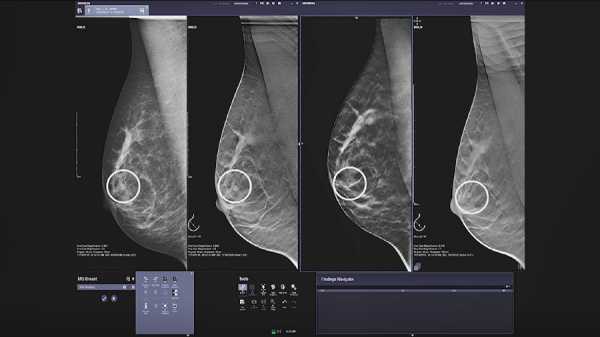 La tomosintesi mammaria HD, una nuova dimensione della mammografia