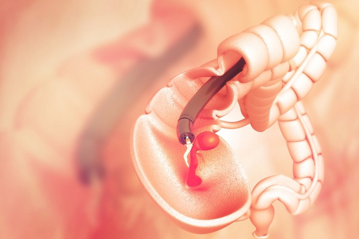 OncoMethylome presenta risultati promettenti del suo programma di screening del cancro colorettale