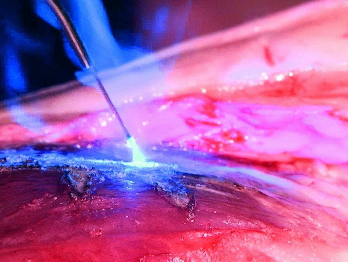 SiroLaser Blue: il blu come sinonimo di precisione chirurgica