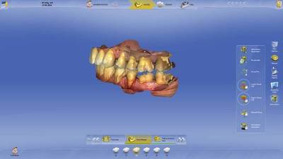 Sirona unisce innovazione e facilità d'uso con il nuovo software odontoiatrico CEREC 4.3
