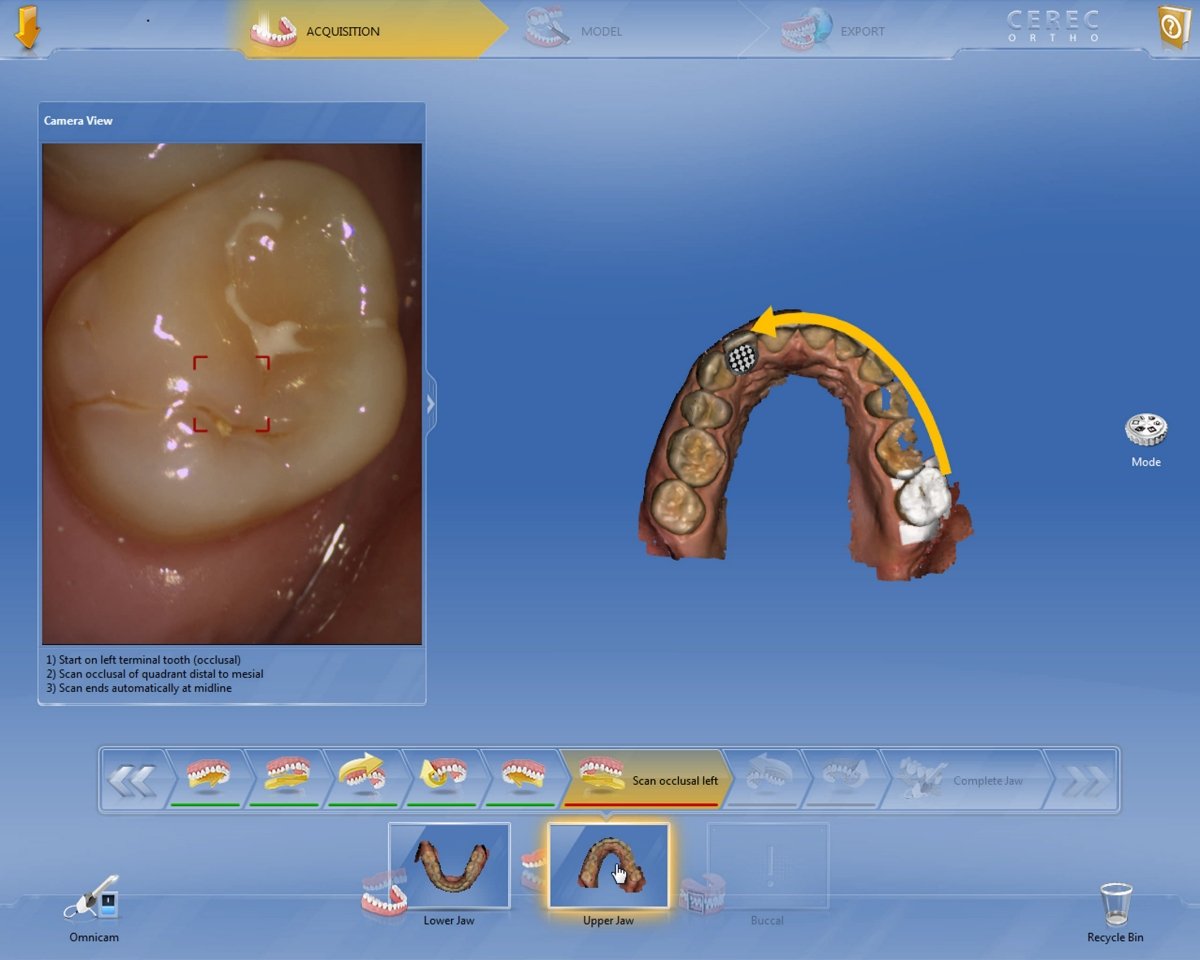 Software CEREC Ortho: impronte digitali per indicazioni ortodontiche