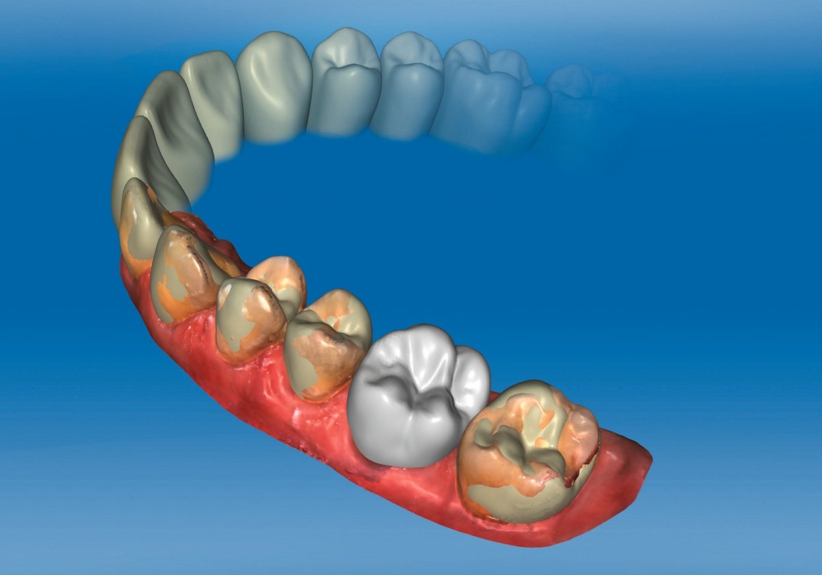 Software CEREC Premium 4.4: più possibilità per il vostro studio dentistico