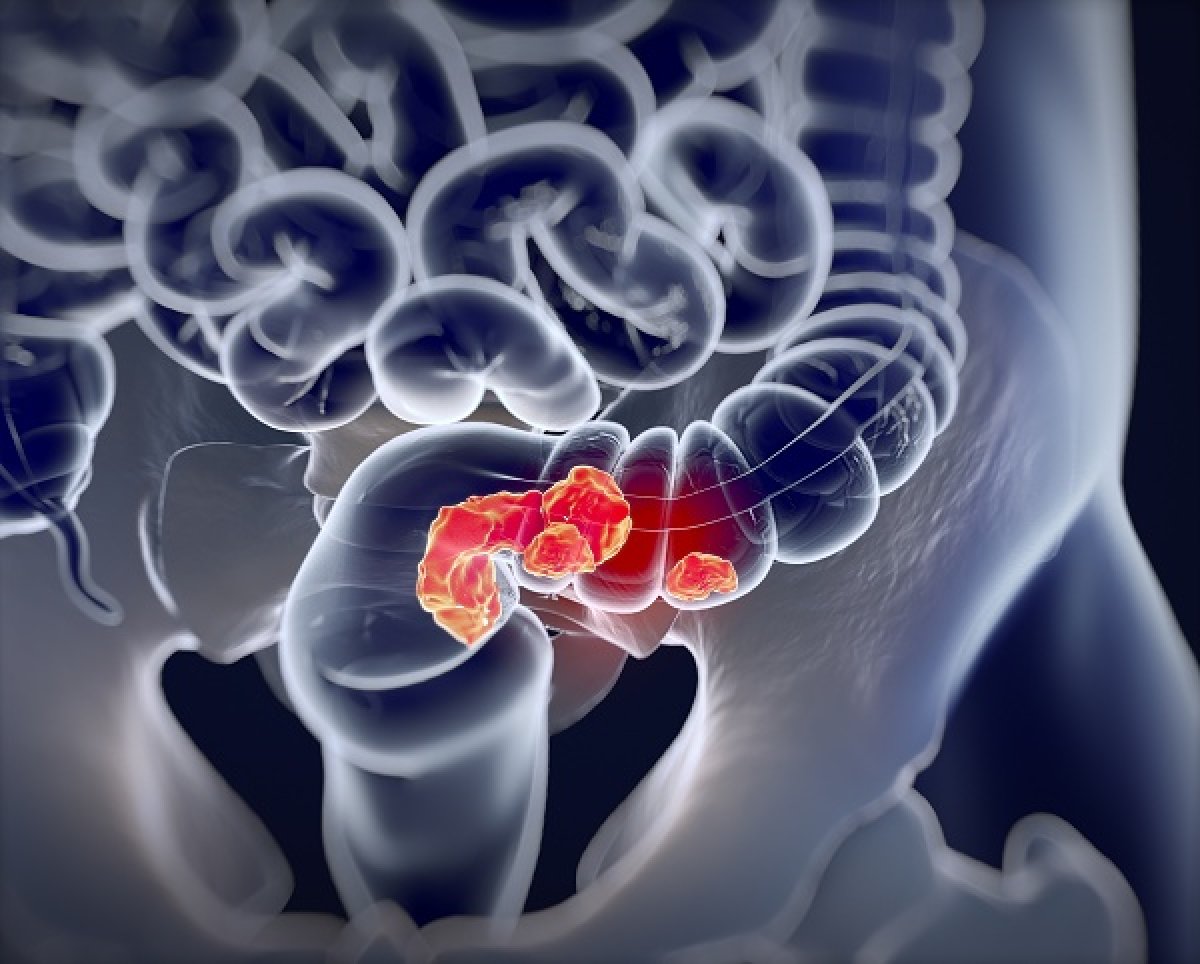 Validare un biomarcatore nel cancro colorettale metastatico